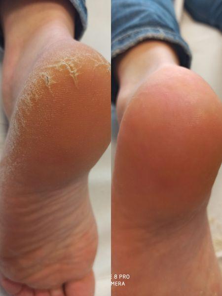 stopa przed i po