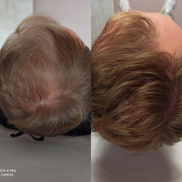 włosy na głowie przed i po